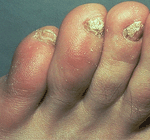 nail-infection
