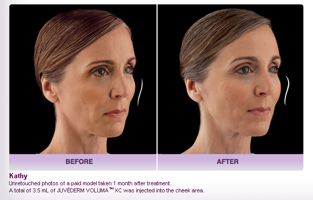 Juvederm and Juvederm Voluma